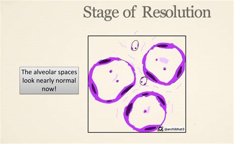 Pathology of Lobar Pneumonia - Pathology Made Simple