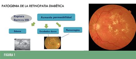 Retinopat A Diab Tica Y Edema Macular Diab Tico Revista Diabetes