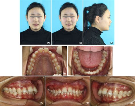 Orthodontic Treatment Of An Adult Class Ii Division 1 Malocclusion With Nonextraction Assisted