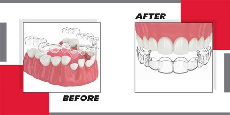 Hyperdontia Before And After