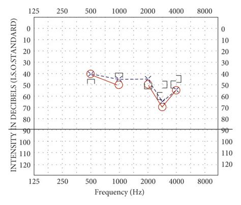 Audiogram Pretreatment Bilateral Mild Sloping To Moderate Severe Download Scientific Diagram