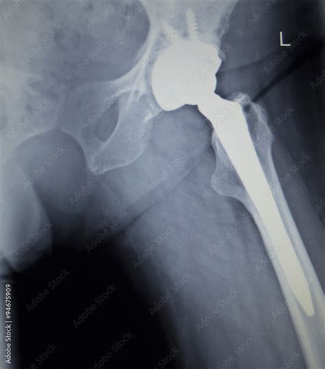 X Ray Scan Image Of Hip Joint Replacement Orthopedic Implant Stock