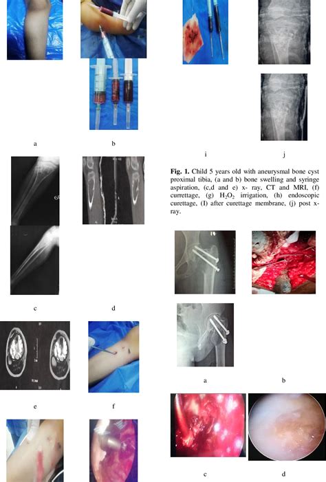 Table 2 From Role Of Endoscopy In Osteolytic Bone Lesion Management