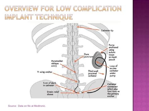 Intrathecal Baclofen