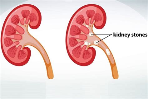 Passing A Kidney Stone What Helps Pass Kidney Stones In Males And Females