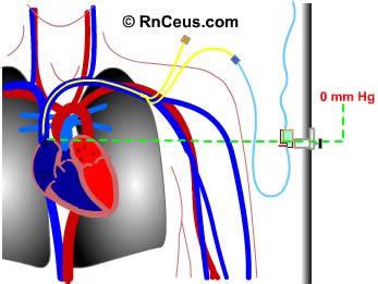 SUPAHNARS: CVP (Central Venous Pressure) monitoring