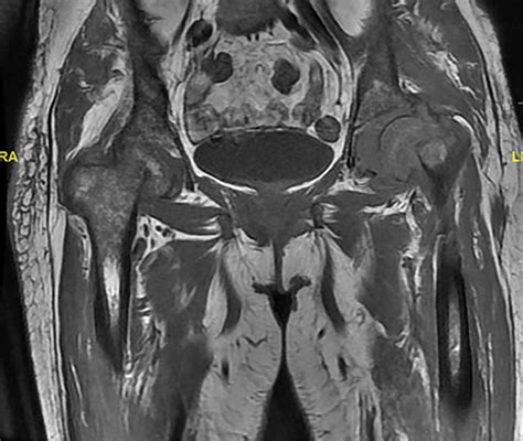 Mri Showing Displaced Fracture Noted At The Left Femoral Neck And