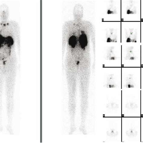 131 Post Thyrogen Whole Body Scan With 3mCi Show Minimal Uptake In The