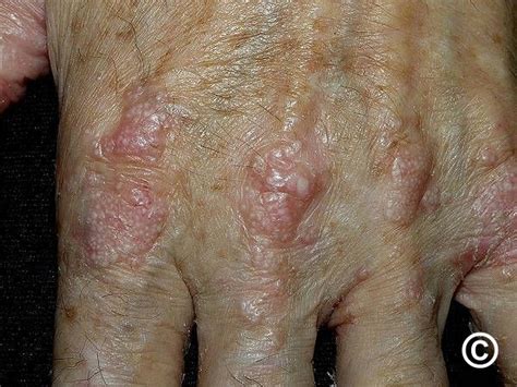 Epidermolysis Bullosa Acquisita