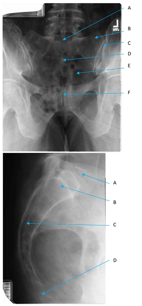 Sacrum Ap Lat And Questions Practice Diagram Quizlet