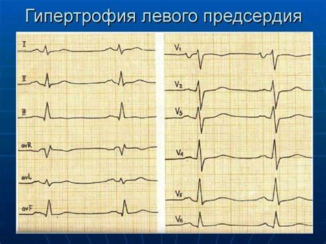 ЭКГ при гипертрофии миокарда - online presentation