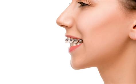 Orthodontics Australia Overjet And Overbite Difference Causes And