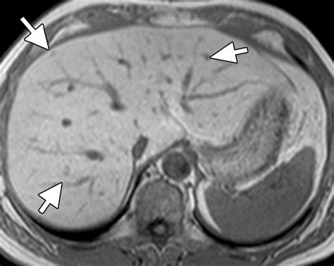 Diffusion Weighted MR Imaging Of The Liver Radiology