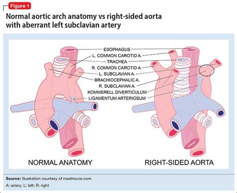 Right Aortic Arch With Aberrant Left Subclavian