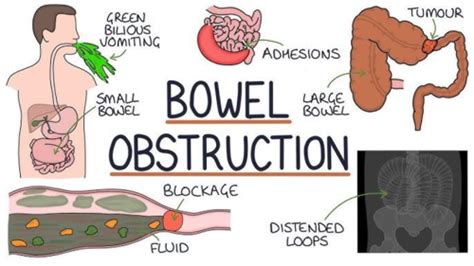 Intestinal Obstruction Flashcards Quizlet