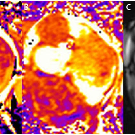 Characterization Of The Left Atrial Mass On Cardiovascular Magnetic