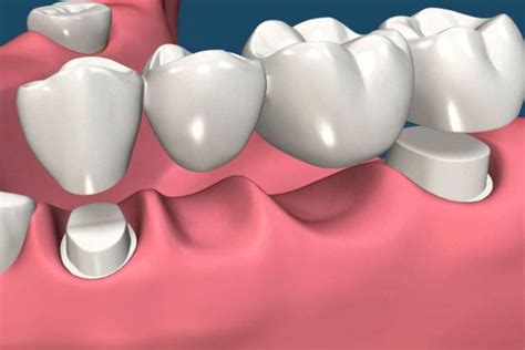 Qué es un puente dental Dentisalut