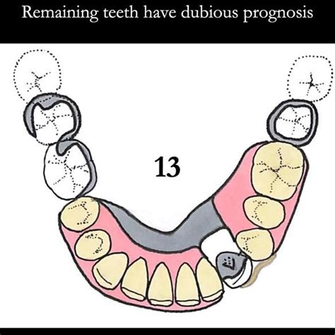 Universal Scandinavian partial denture designs | Finlay Sutton - Denture Education