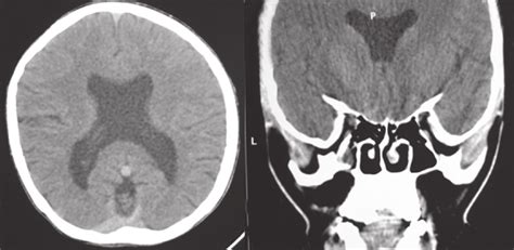 Axial Left And Coronal Right Ct Images Of The Brain Show An Absent