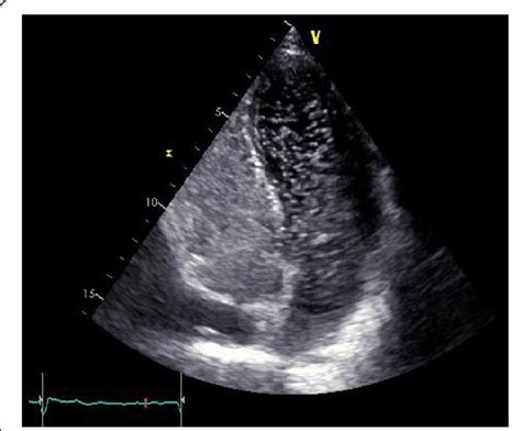 Contrast Enhanced Transthoracic Echocardiography Passage Of