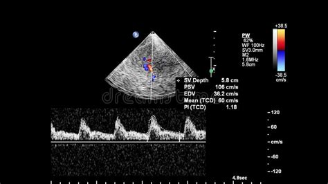 Pulse Wave Doppler Ultrasound Examination. Stock Image - Image of echocardiogram, effect: 166874121