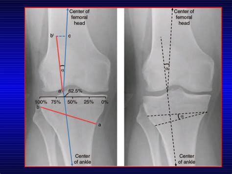 Medial Opening Wedge High Tibial Osteotomy