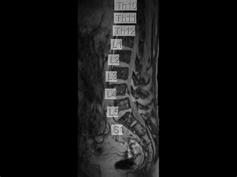 Lumbar Spine Disc Herniation Philips Mr Body Map