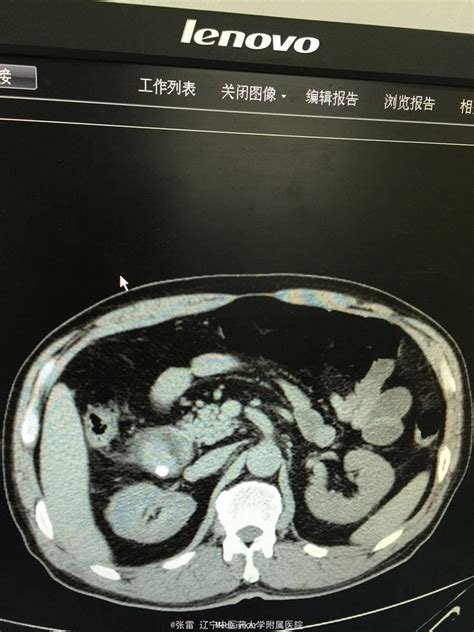 胆囊结石伴急性化脓性胆囊炎 医联