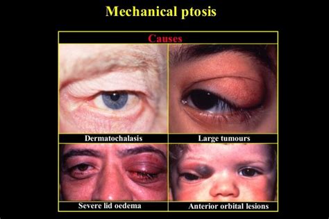 07 Ptosis