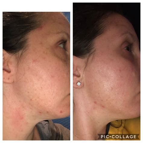 One Month Into 025 Tret Rtretinoin