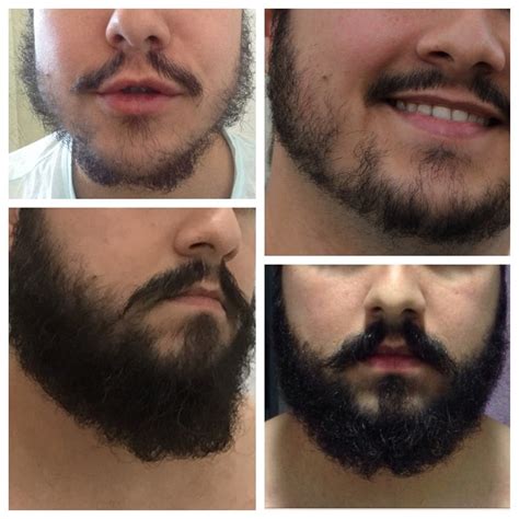 Minoxidil Barba Para que Serve Como Usar Preço e Onde Comprar