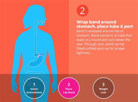 Lap Band® Surgery All You Need To Know Bariatric Surgery Source