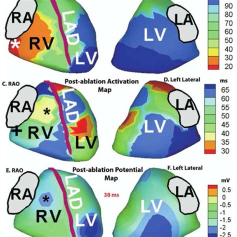 The right anterior oblique and left lateral projections during 3 time ...