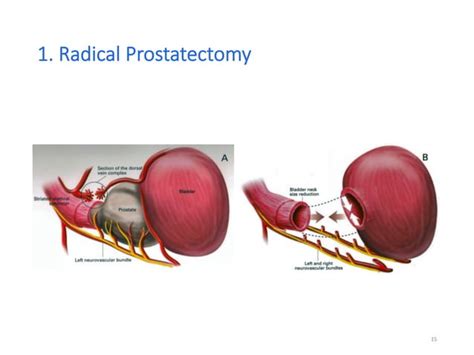 Penile Rehabilitation After Prostate Cancer Treatment Is There An