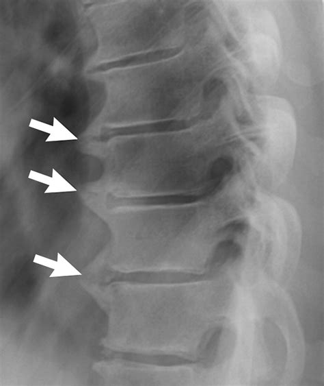 Diffuse Idiopathic Skeletal Hyperostosis Cervical Spine