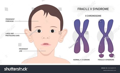 Fragile X Syndrome Emotional Issues