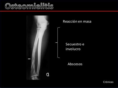 12 Osteomielitis