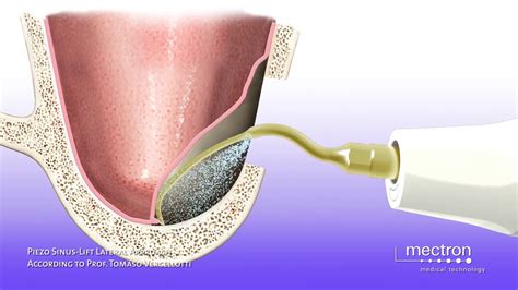 Piezosurgery Sinus Lift Technique By Lateral Approach Animation