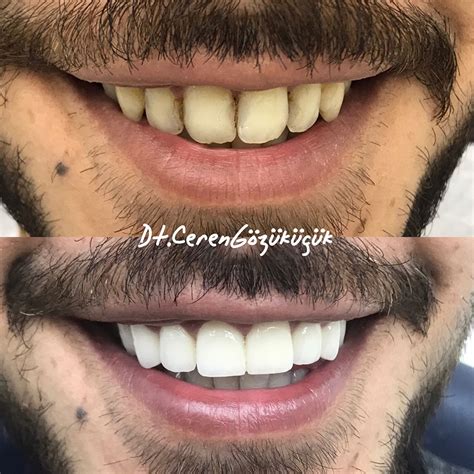 Zirkonyum Kaplama Ceren Dental Clinic