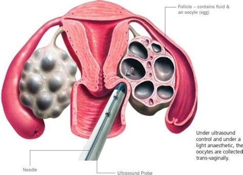 IVF