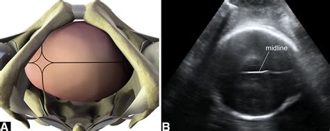 The Use Of Intrapartum Ultrasound To Diagnose Malpositions And Cephalic Malpresentations