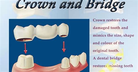 Dental Posters to Educate Patients: Crown and Bridge