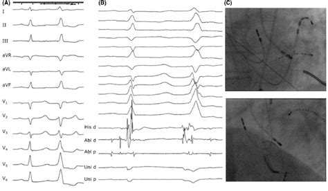 A Morphology Of The Second Pvc B Earliest Activation Is Seen Under