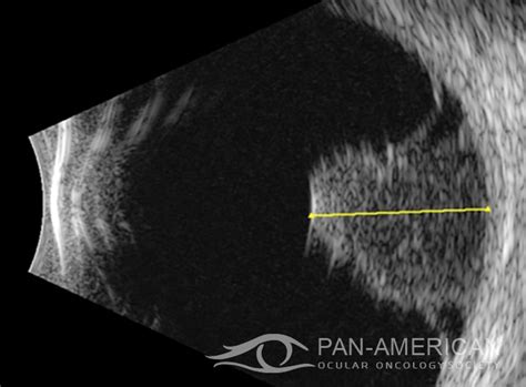 Choroidal Melanoma With Break In Bruchs Membrane Sociedad
