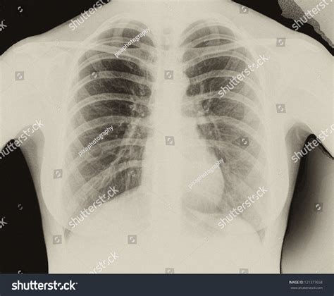 Xray Image Human Healthy Chest Mri Stock Photo Shutterstock