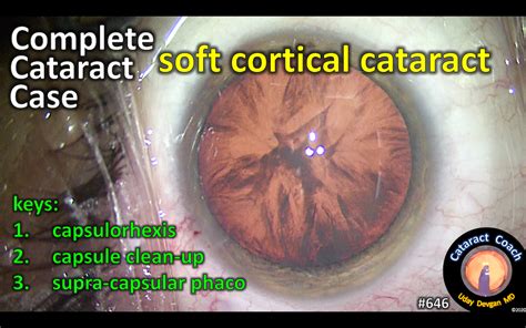 Complete Case Cortical Cataract Cataract Coach