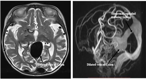 (A) MRI T2 demonstrating dilated vein of Galen, straight sinus and ...