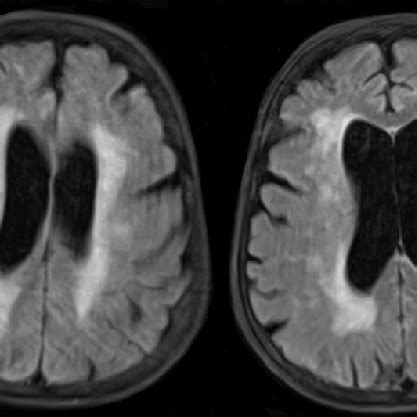 MRI of the brain showing severe diffuse atrophy for her age with... | Download Scientific Diagram