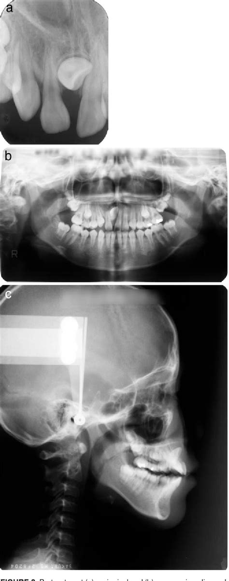 Figure 2 From Orthodontic Treatment Of An Impacted Dilacerated