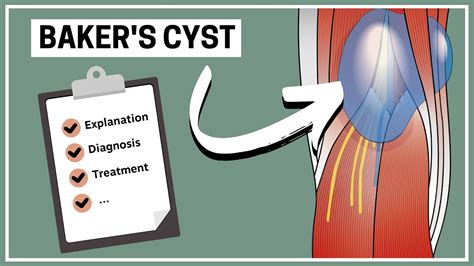 What Is A Baker S Cyst Explanation Diagnosis And Treatment Youtube